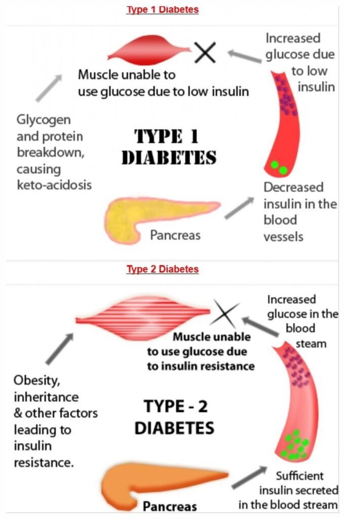 Diabetes type 1and2Diagram