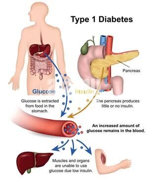 मधुमेह के लक्षण कारण प्रकार और आहार उपचार (Symptoms, Causes, Types and Diet Treatment of Diabetes)