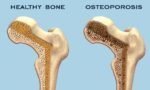 Osteoporosis: 4 Symptoms(2023)