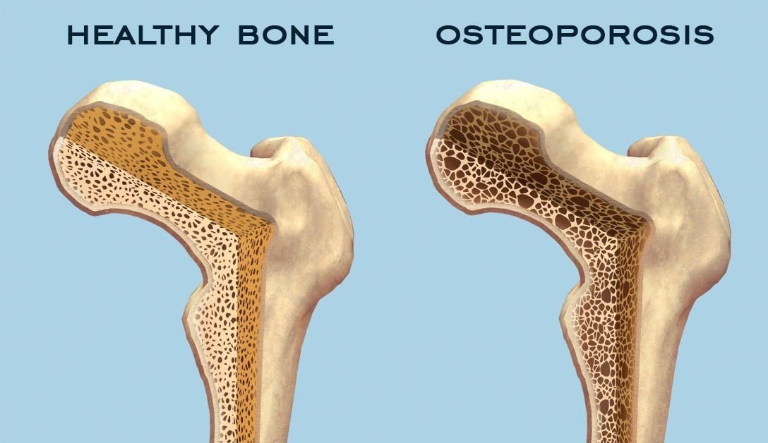 Osteoporosis