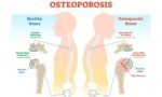 Osteoporosis Bones Health-2023