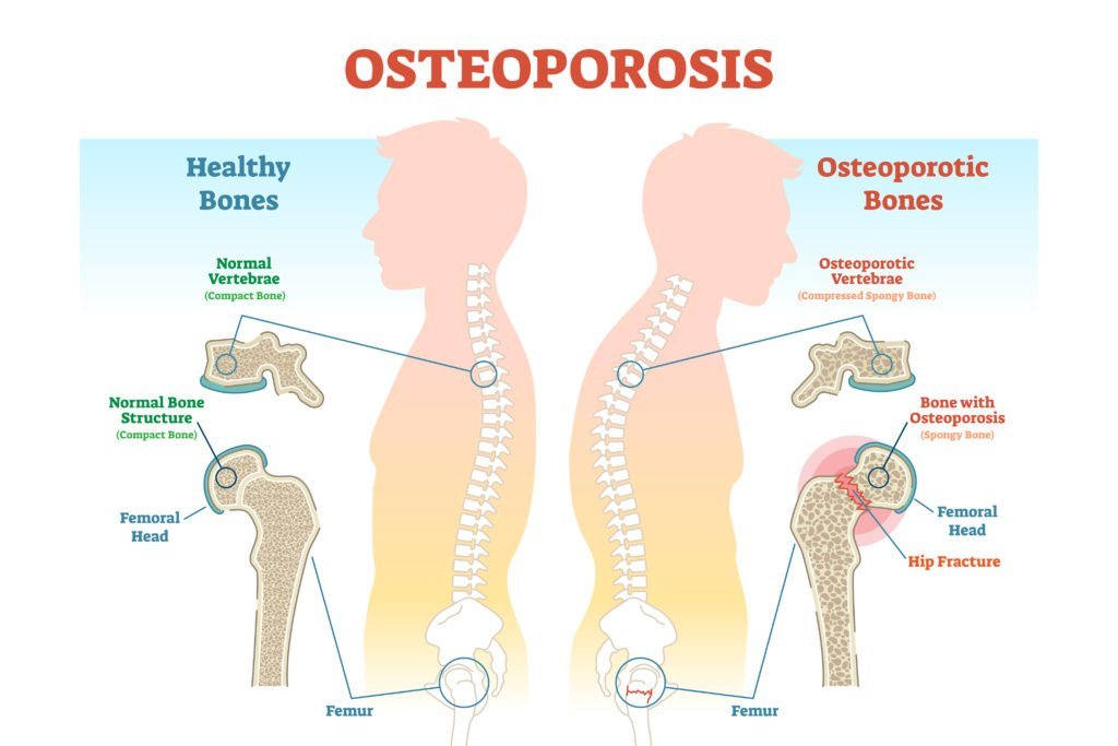 Osteoporosis  Bones Health